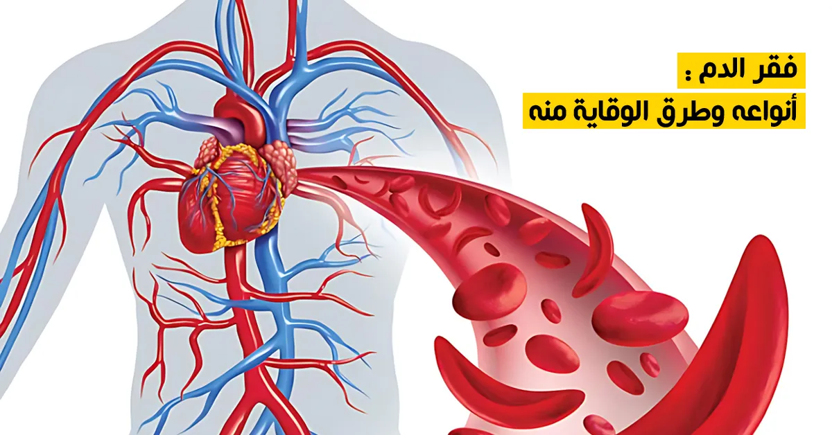 فقر الدم : أنواعه وطرق الوقاية منه